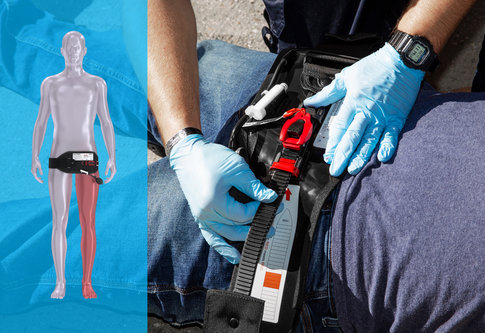 websiteassets_20231121_applicationsiteswithoverlay__inguinalgroin_english_kgs image Inguinal bleeding how to stop
